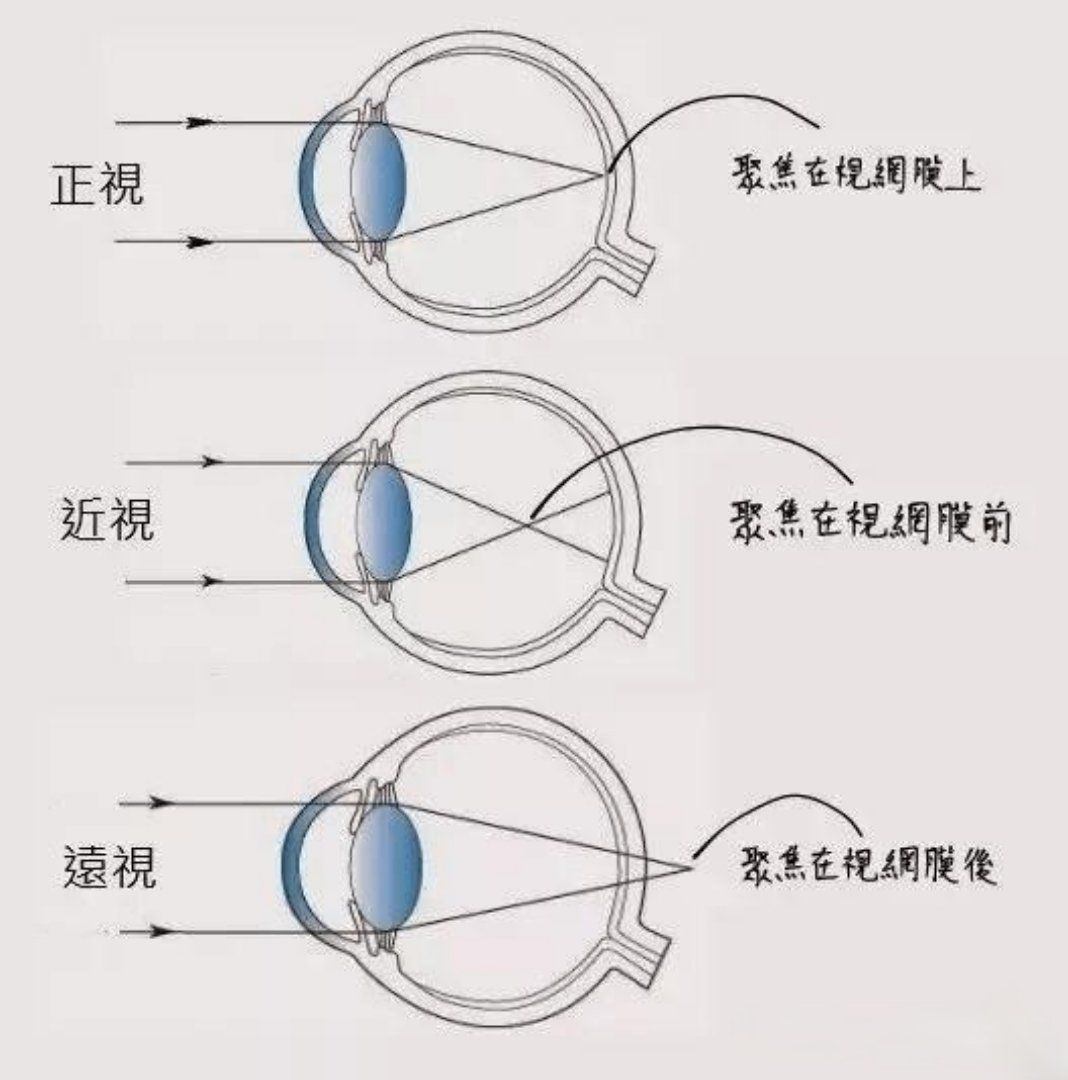 远视眼