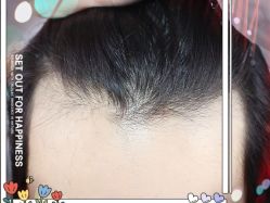 -大麦微针植发全国连锁