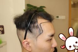 点击看大图 -大麦微针植发丨全国连锁