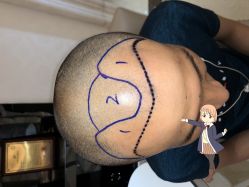 -大麦微针植发丨全国连锁