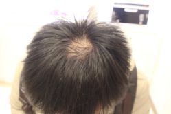 -大麦微针植发丨全国连锁