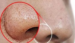 -瑶芳清颜草本祛痘