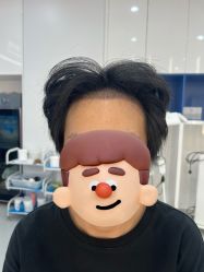 -大麦微针植发全国连锁