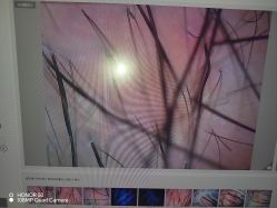 -碧莲盛·不剃发植发