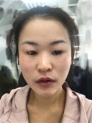 体验后-叶美人医疗美容