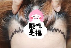 -大麦微针植发全国连锁