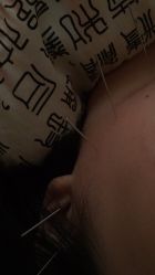 -肥三针腧穴瘦身馆