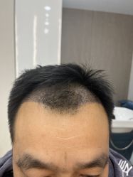 -大麦微针植发全国连锁