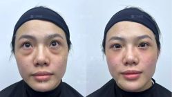 体验前-广州健丽·去眼袋医疗美容机构