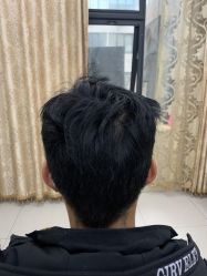 -大麦微针植发丨全国连锁