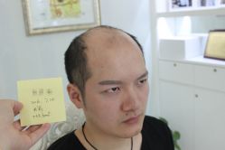 -大麦微针植发丨全国连锁