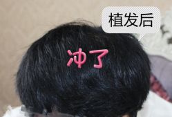 -大麦微针植发全国连锁