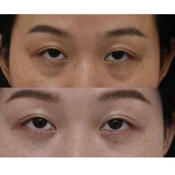 -广州健丽·去眼袋医疗美容机构