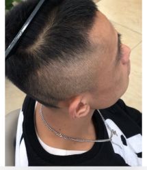 -大麦微针植发全国连锁