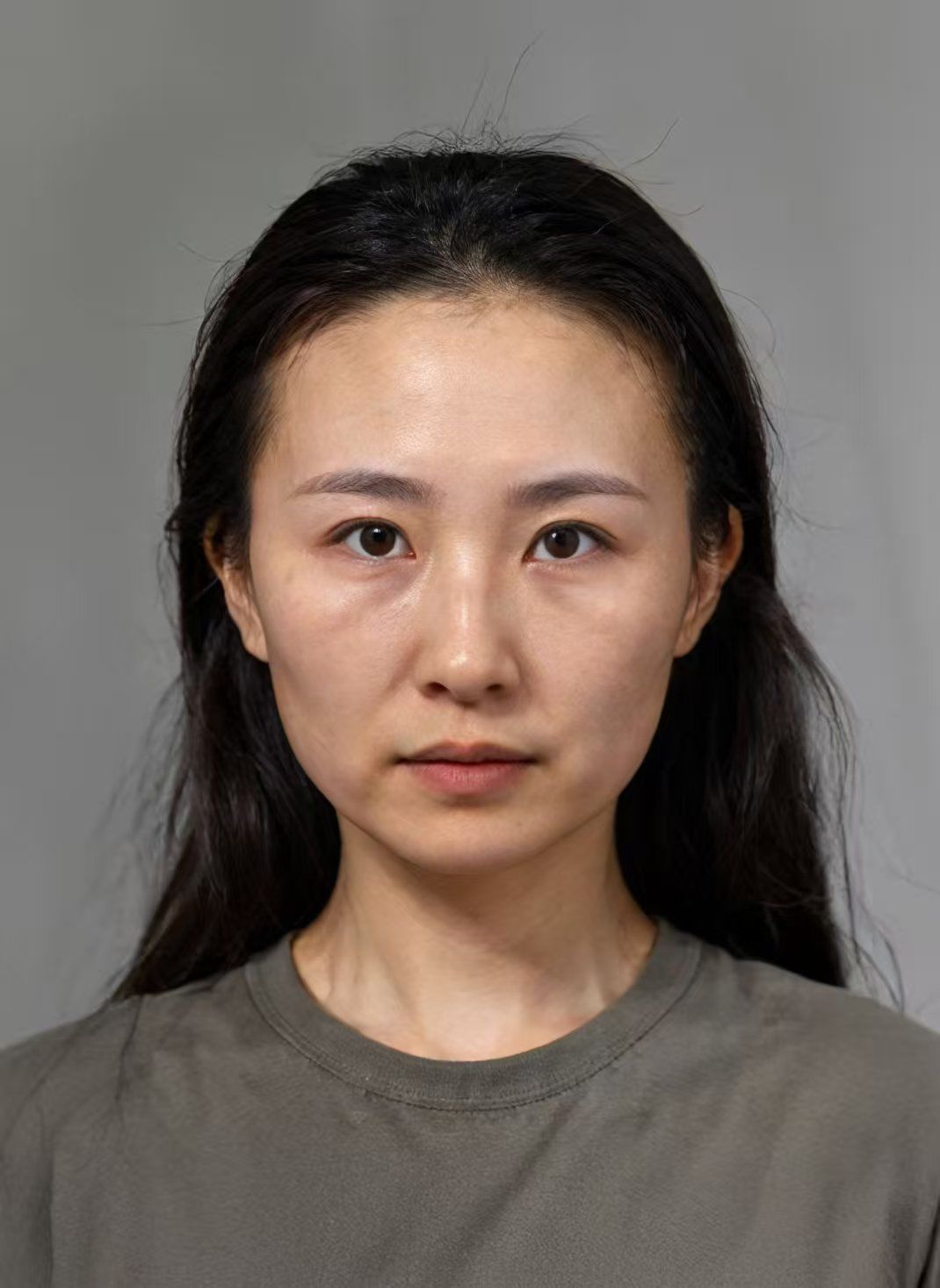 玻尿酸鼻基底苹果肌注射体验后7天效果分享