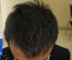 -大麦微针植发丨全国连锁