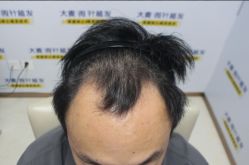 -大麦微针植发丨全国连锁
