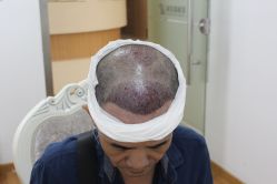 -大麦微针植发丨全国连锁