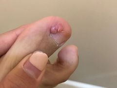 -世龙世家灰指甲鸡眼脚气甲沟炎跖疣护理(通州店)