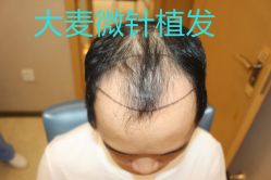 -大麦微针植发丨全国连锁