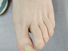-祖传修脚甲沟炎灰指甲鸡眼