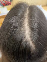 点击看大图 -碧莲盛·不剃发植发