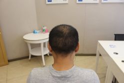 点击看大图 -大麦微针植发丨全国连锁