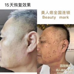 -美人痣全国连锁