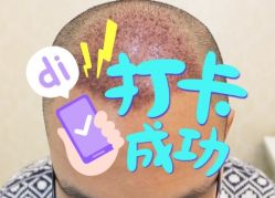 -大麦微针植发全国连锁
