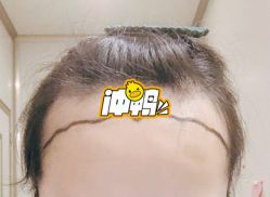 -大麦微针植发全国连锁