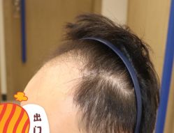 -大麦微针植发全国连锁