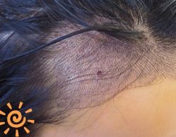 -大麦微针植发丨全国连锁