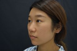 体验后-成都西区医院整形美容