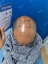 -碧莲盛·不剃发植发