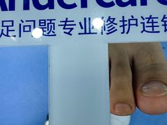 -Andrew指甲专科灰指甲·甲沟炎矫正·3D步态矫形鞋垫定制(浦三路店)