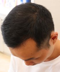 -大麦微针植发全国连锁