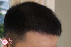 -大麦微针植发丨全国连锁