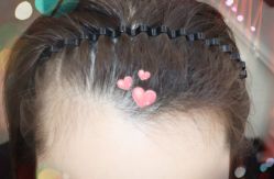 -大麦微针植发全国连锁