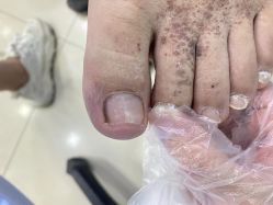 点击看大图 -德哥灰指甲脚气甲沟炎跖疣护理