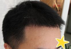 -大麦微针植发丨全国连锁