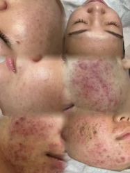 -瑶芳清颜草本祛痘