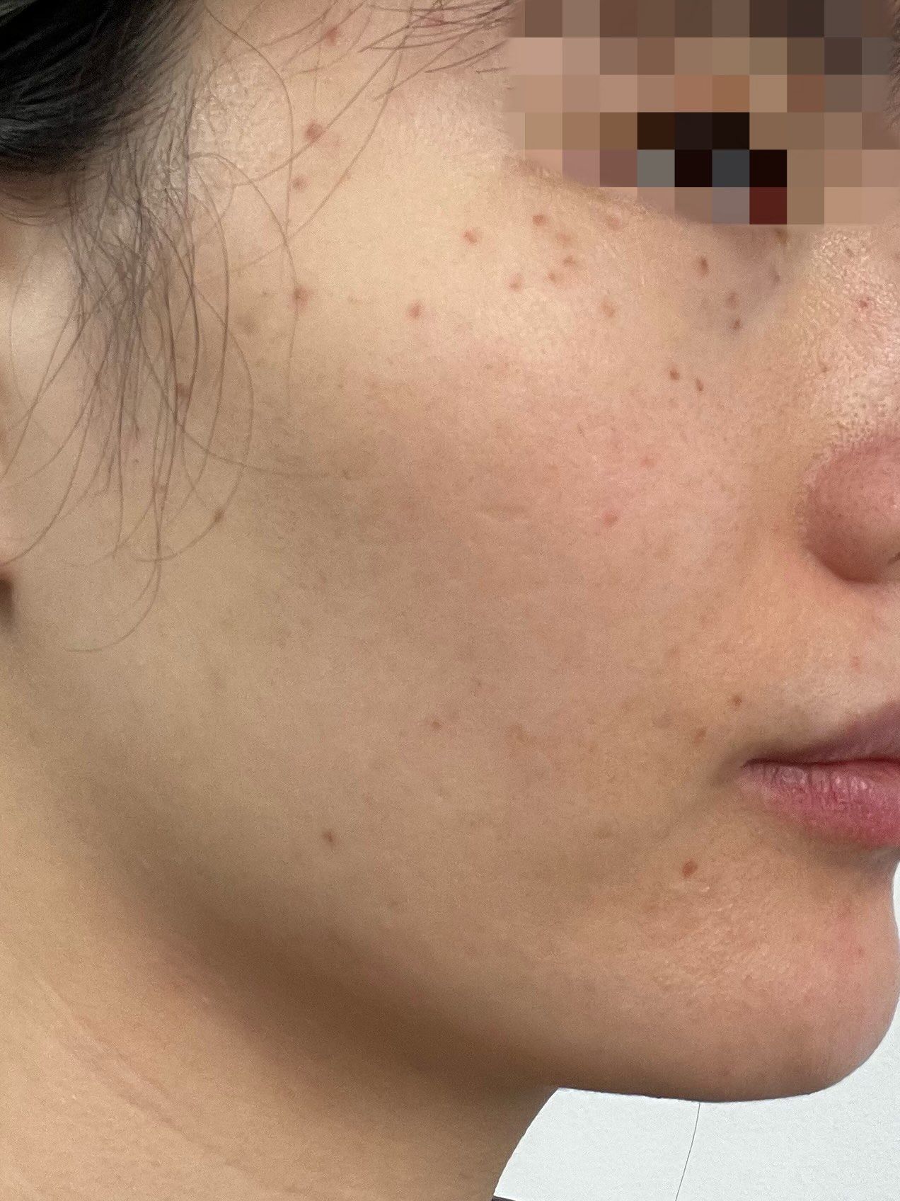 超皮秒祛斑体验后7天