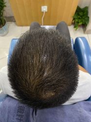 -大麦微针植发全国连锁