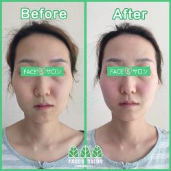 -FACE·日本小颜矫正美容整骨サロン
