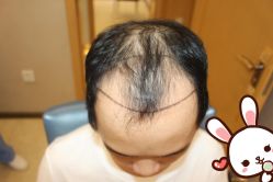 -大麦微针植发丨全国连锁