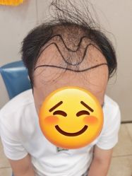 -大麦微针植发全国连锁