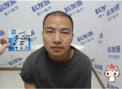 -大麦微针植发丨全国连锁