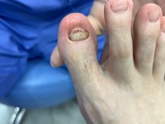 -Andrew指甲专科灰指甲·甲沟炎矫正·3D步态矫形鞋垫定制(浦三路店)