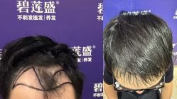 -碧莲盛·不剃发植发