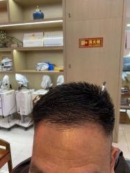 体验后-大麦微针植发丨全国连锁